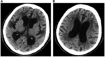 Rapidly progressive adult-onset neuronal intranuclear inclusion disease beginning with autonomic symptoms: a case report